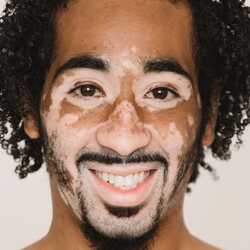 greeting e-card Black man with vitiligo skin